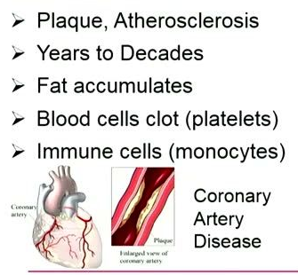Two adjacent illustrations: on the left, a diagram of a human heart showing the coronary arteries highlighted in red; on the right, a detailed cross-section of a coronary artery showing yellow plaque buildup narrowing the lumen.
